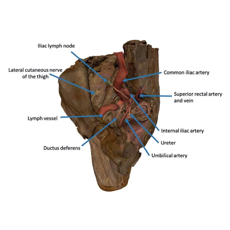 3D Printed Male Hemipelvis and Thigh