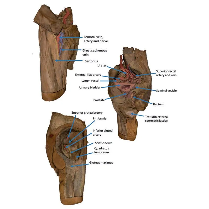 3D Printed Male Hemipelvis and Thigh
